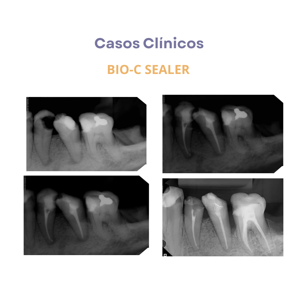 Sellador de conductos radiculares biocerámico