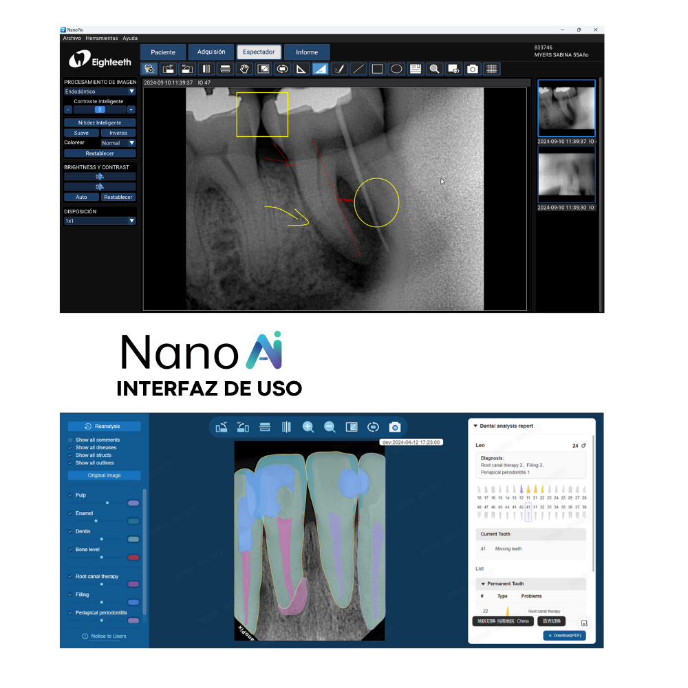 Sensor Intraoral NanoPix – Eighteeth