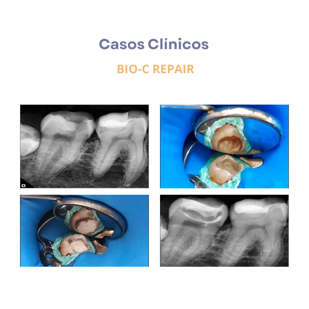 Material reparador biocerámico (masilla)