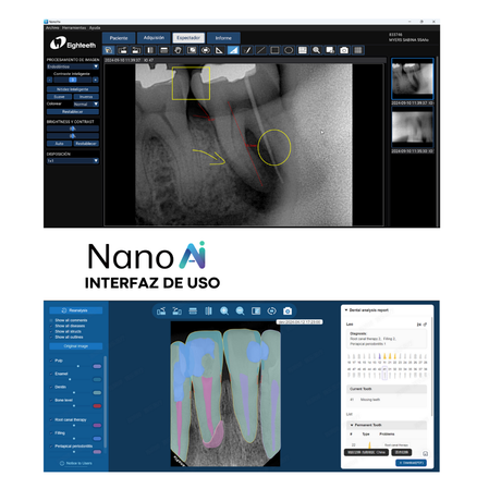 Sensor Intraoral NanoPix – Eighteeth